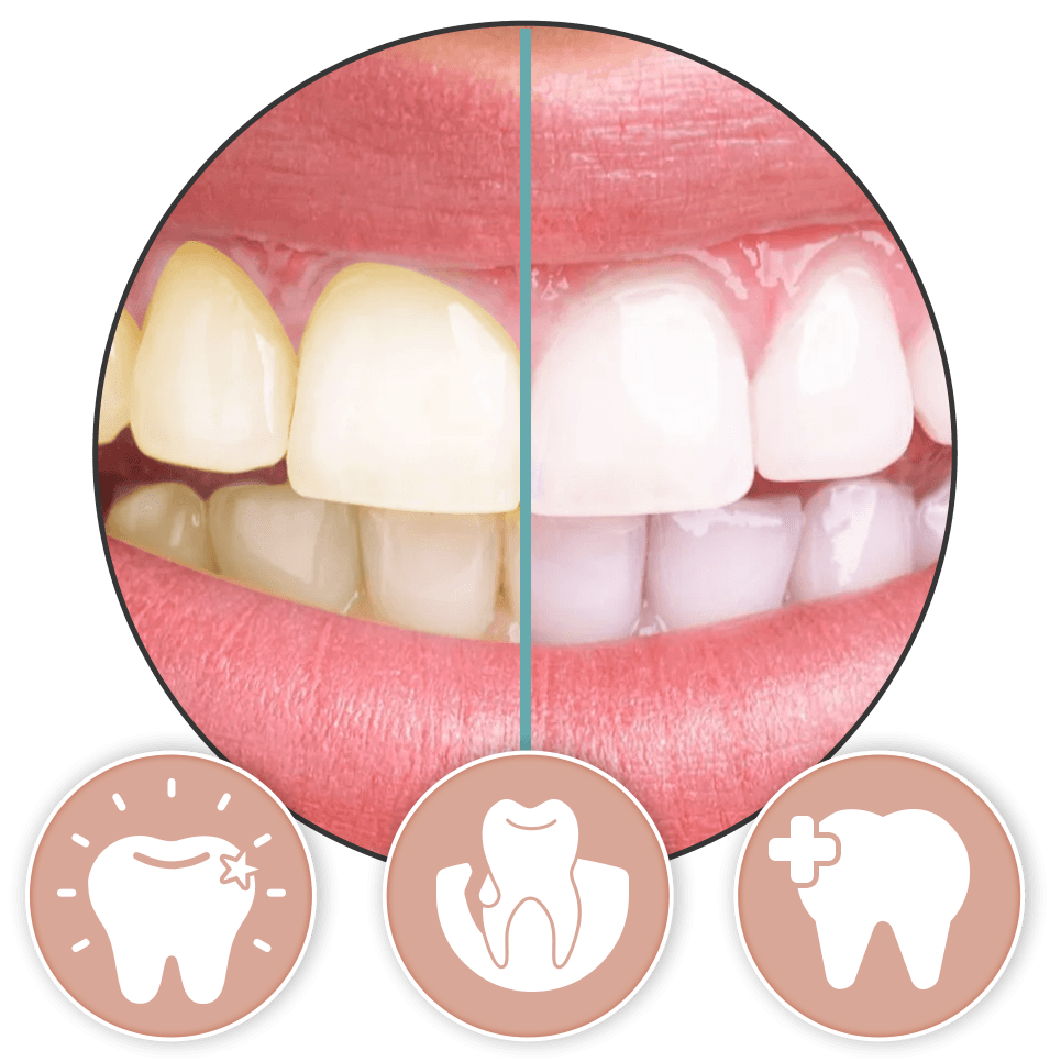 Before and after comparison of teeth whitened with Dentivital